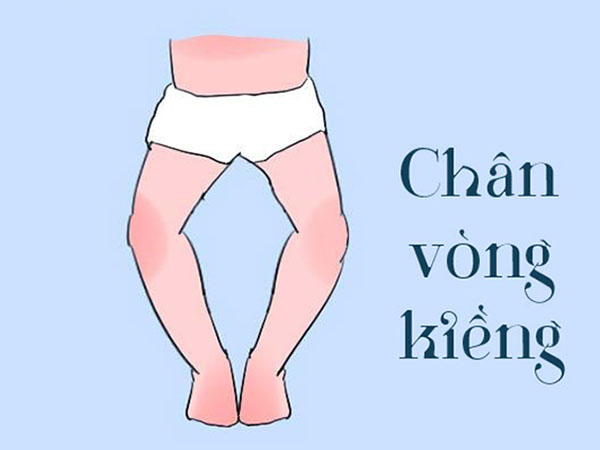 Tình trạng khi bị chân vòng kiềng